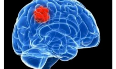 IGMC में बिना चीर फाड़ के ब्रेन टयूमर का एंडोस्कोपी तकनीक से ऑपरेशन सफल